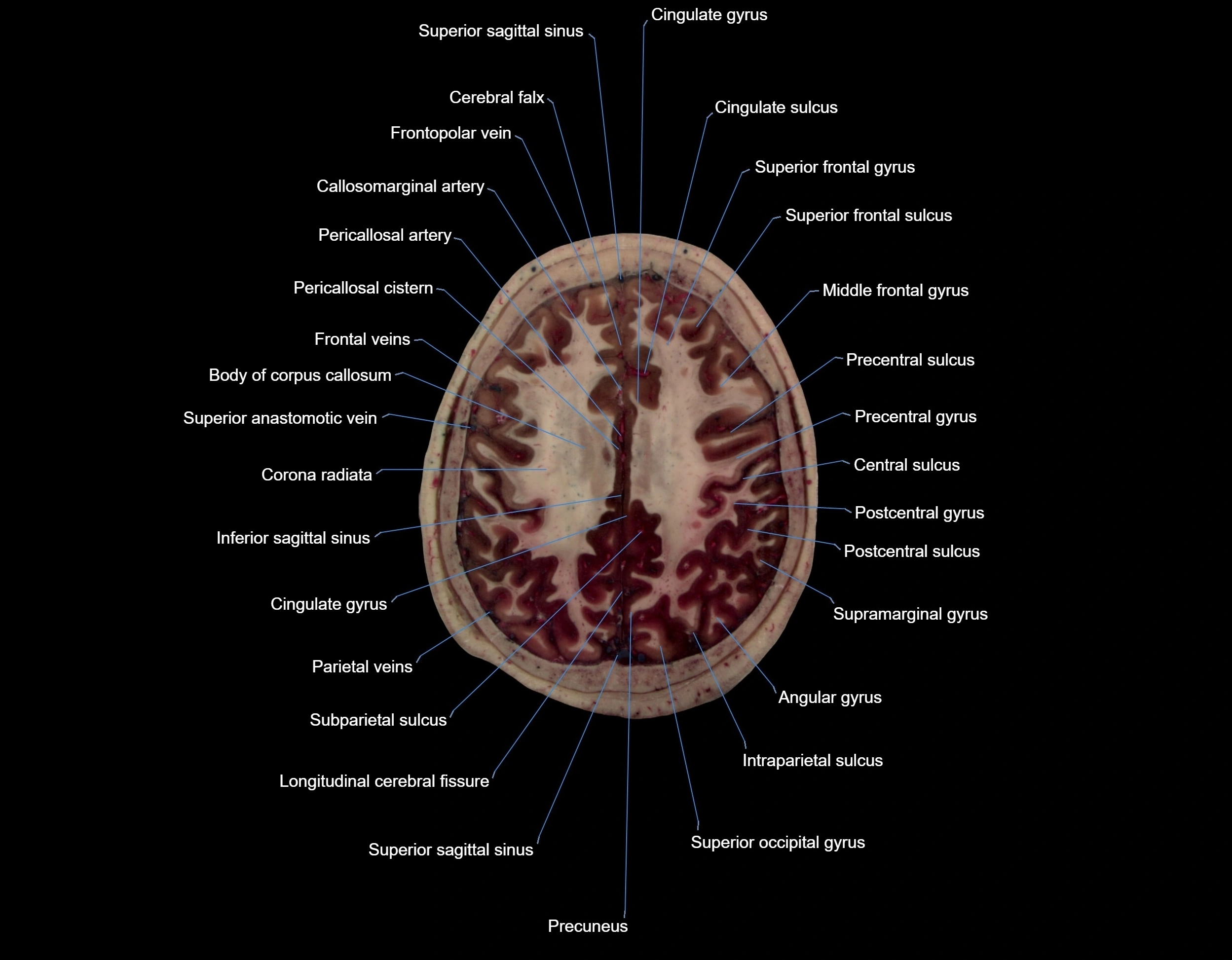 MRI Brain axial cross sectional radiology anatomy 3T image  -img-000058.webp